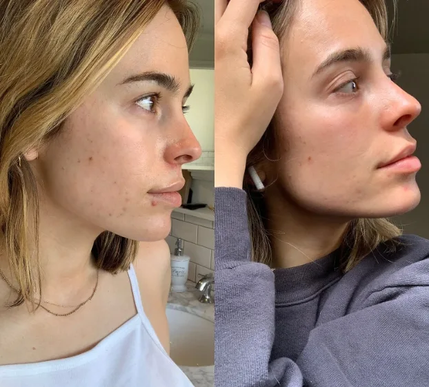 retinol krem akne sivilce oncesi ve sonrasi