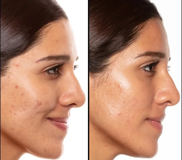 retinol serum oncesi sonrasi